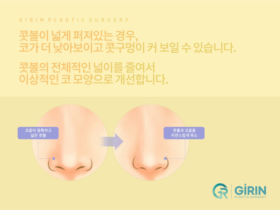 여자코성형 원하는 라인 고려하여 관련 이미지 10