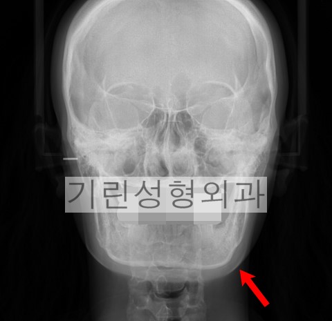 귀뒤사각턱수술 후 부작용: 효과없는 경우 관련 이미지 1