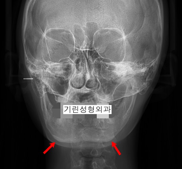 일반 긴곡선사각턱 후 부작용 : 이차각 및 U라인 관련 이미지 1