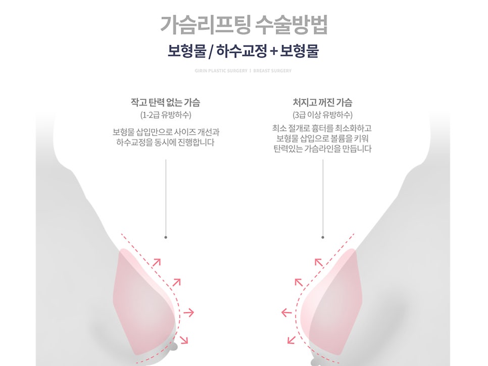 출산후 가슴수술 필요하다 느낀다면 관련 이미지 5
