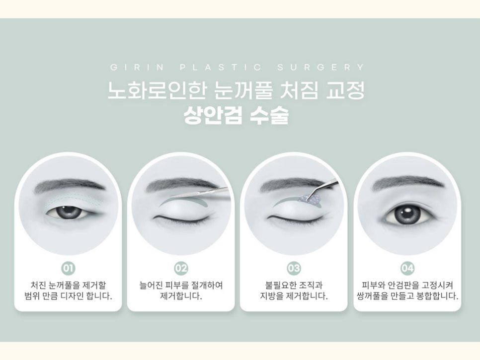 상안검수술회복기간 확인하자 관련 이미지 6