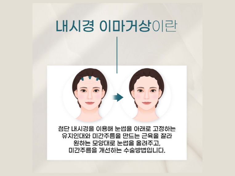 이마거상수술 주름을 개선하는 관련 이미지 4