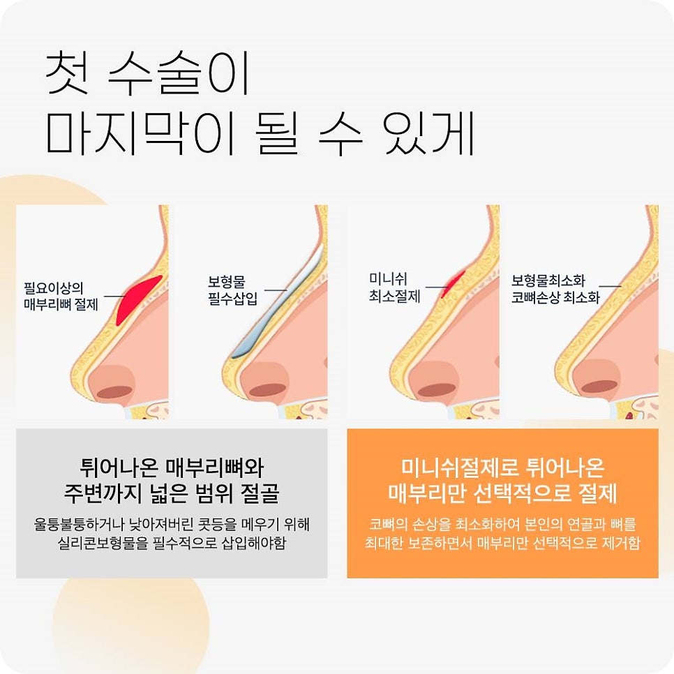매부리코수술? 콧대만 깎는다고 해결 될까? 관련 이미지 8