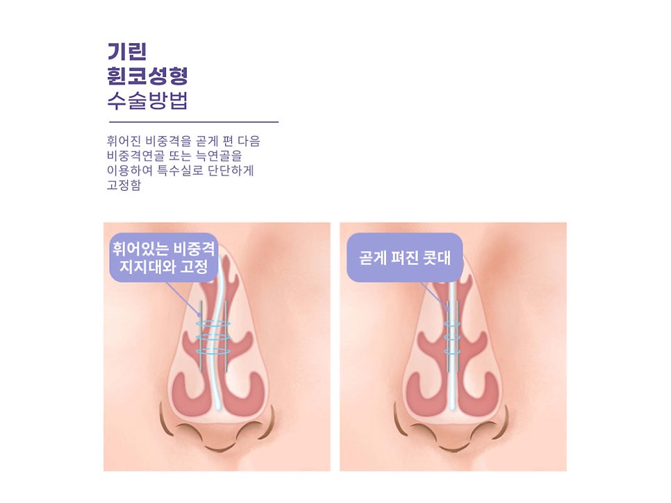 서울코수술 생김새에 따라 다르게 관련 이미지 8