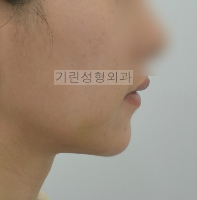 보형물을 이용한 무턱수술과 지방이식을 이용한 방법 관련 이미지 2