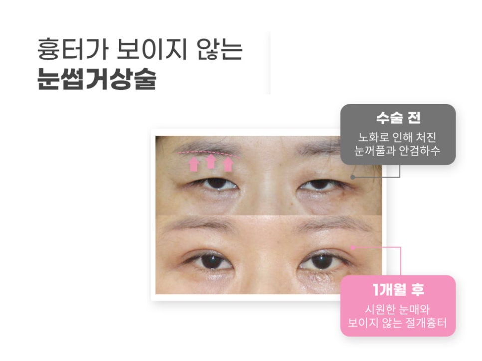 강남눈성형 눈가 주름 개선을 위해 관련 이미지 12