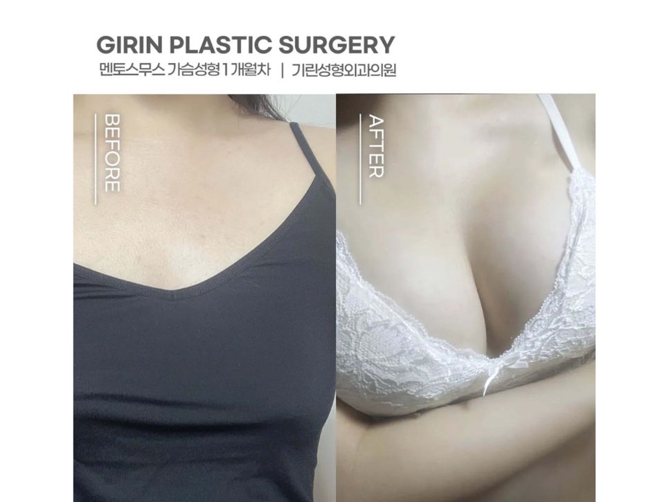 절벽가슴수술 촉감까지 고려하며 관련 이미지 2