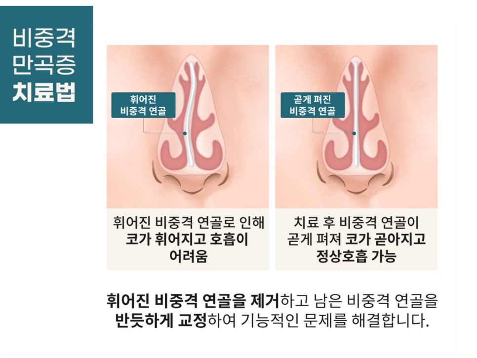 기능코수술 불편함을 해결하자 관련 이미지 9