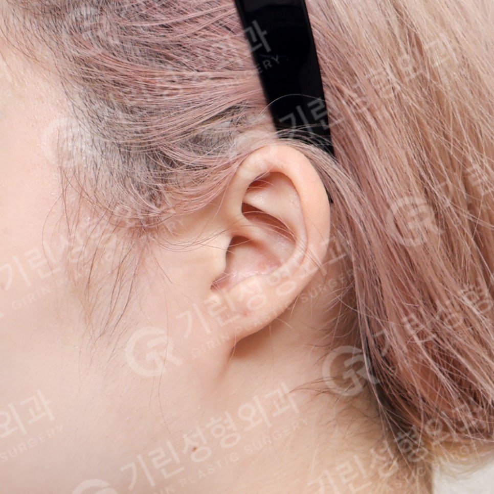 [기린성형외과의원] 누운귀 칼귀 작은귀 고민 해결_엘프귀 요정귀 귀필러 관련 이미지 9