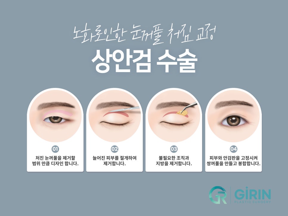 중년눈성형잘하는곳 찾았다면 관련 이미지 5