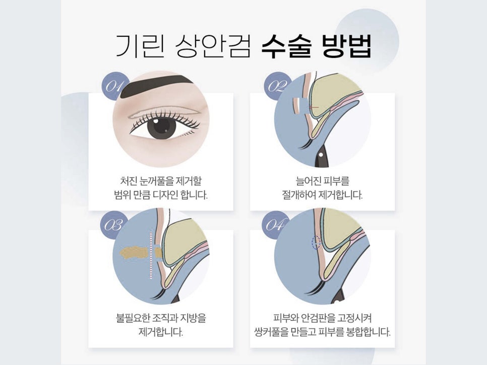 상안검하안검수술 빠른 회복을 위해 관련 이미지 5