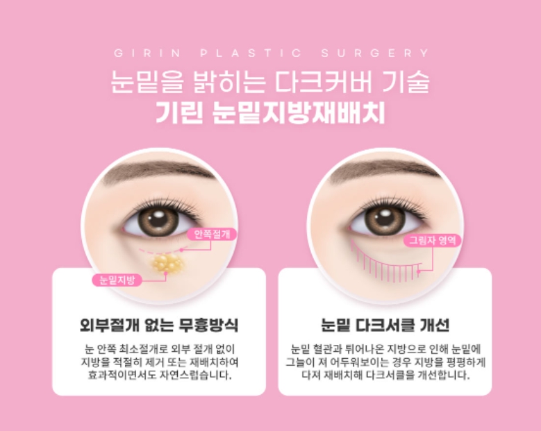 눈밑지방제거수술 하안검 선택의 폭이 넓어졌어요! 관련 이미지 4