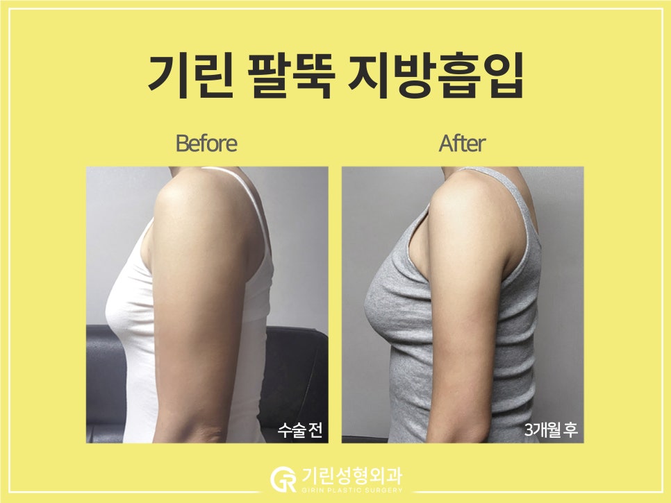 [기린 성형외과] 예쁜 라인 찾는 체형별 팔뚝지방흡입 관련 이미지 4
