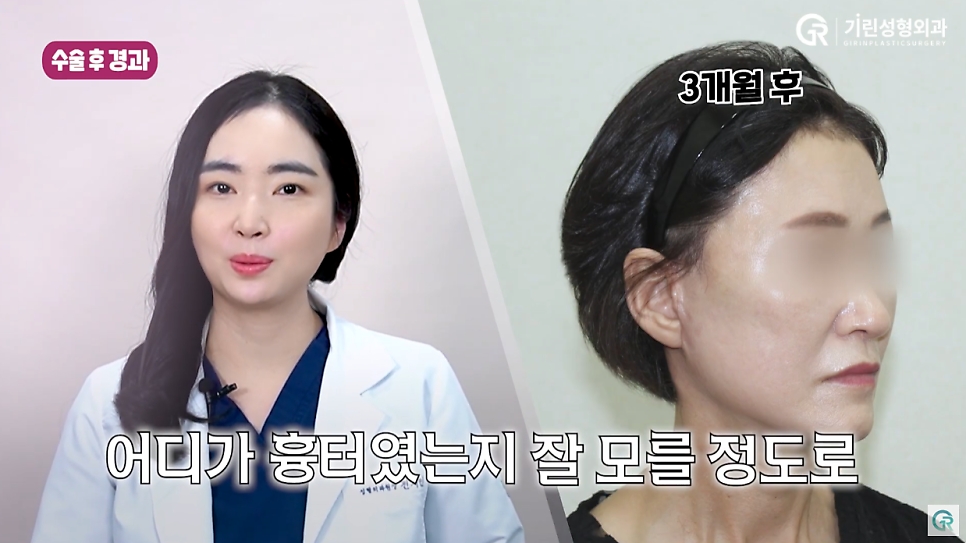 [기린성형외과의원] 부모님들 사이에서 유행하는 성형_안면거상 수술일지 관련 이미지 8