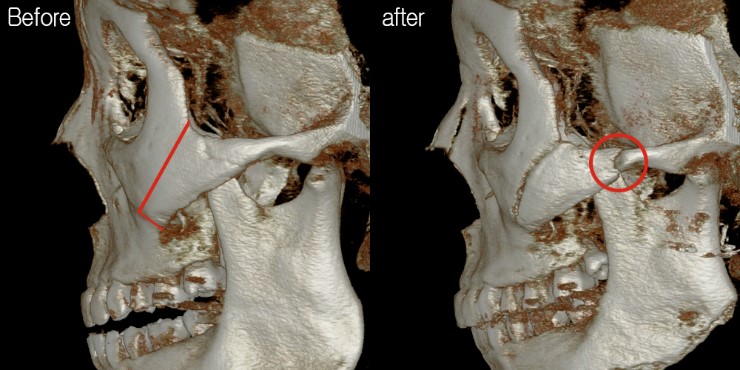 광대 부분절골- 광대비고정사례 관련 이미지 4