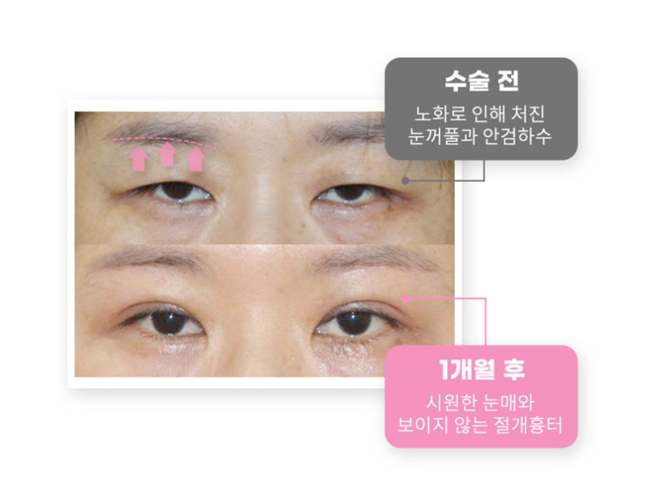 눈썹거상술후기 확인하고 싶다면 관련 이미지 3