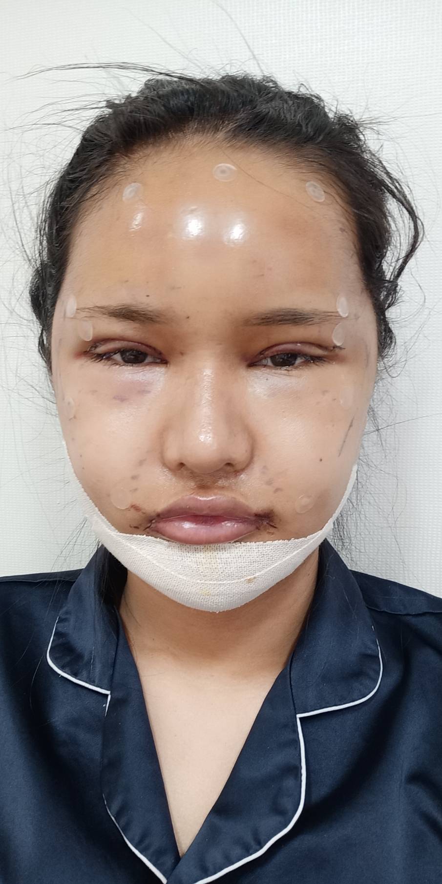 [사각턱축소 최다수술 이승룡원장] 태국에서 온 그녀의 윤곽 수술 후기 리얼 스토리&hearts; 관련 이미지 3