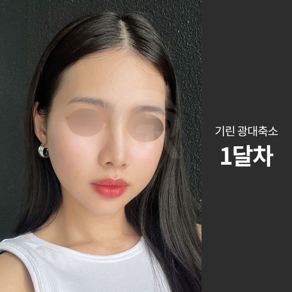 광대가 큰 얼굴, 축소술은 인상을 조율하는 기준점입니다 관련 이미지 4