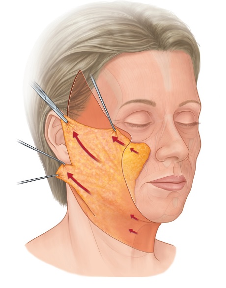 [공유] 안면거상술 고민중이시라면 꼭 읽어보세요! 다른 시술이 아닌 안면거상술을 선택해야 하는 해부학적 근거 관련 이미지 1