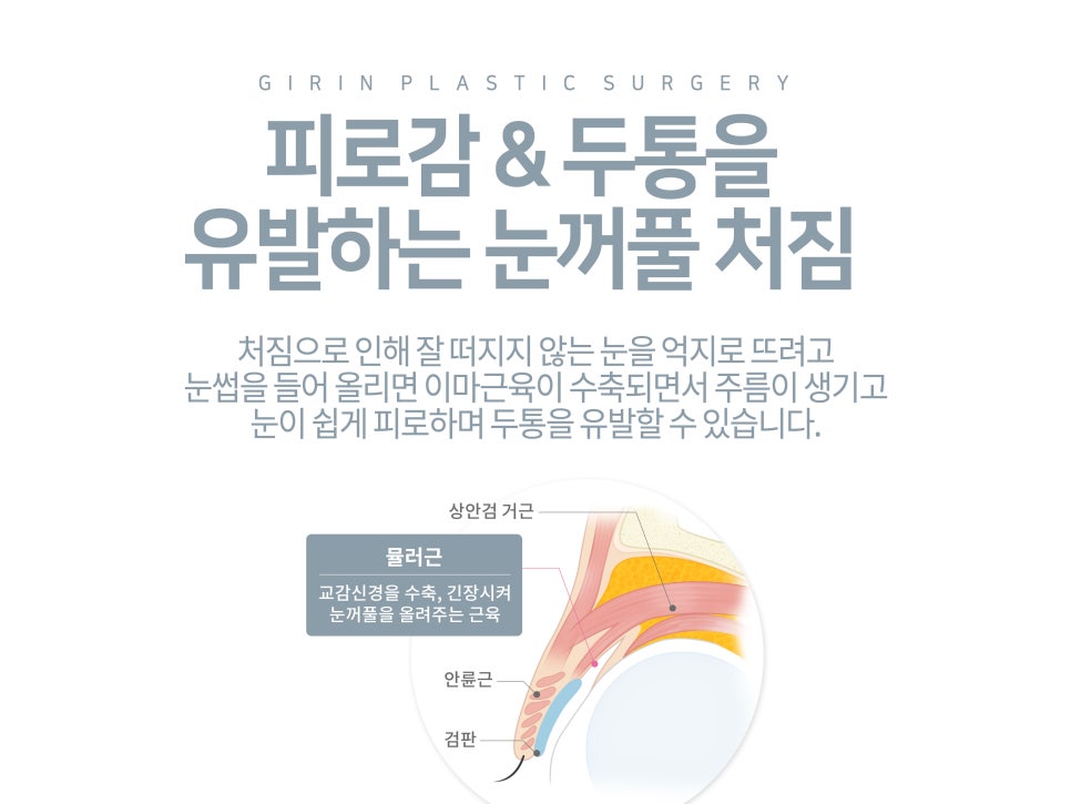 강남눈성형 눈매 개선 만족스럽게 관련 이미지 4