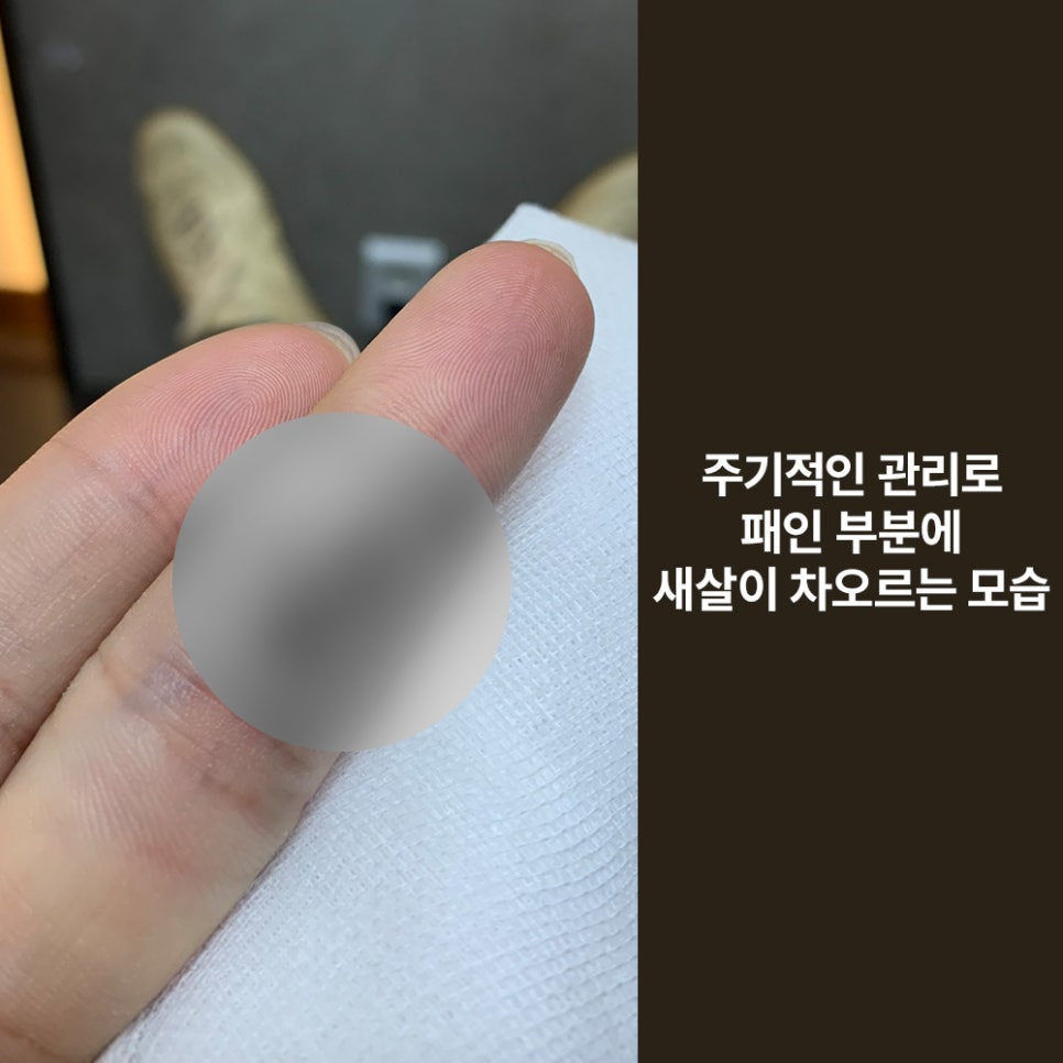 Girin Plastic Surgery for Finger Laceration Suturing, Skin Grafts, and Scar Care image 6