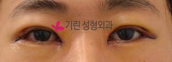 쌍꺼풀수술비용과 전후 관련 이미지 2