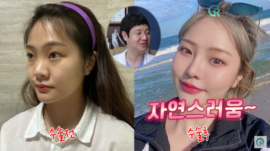[기린성형외과의원] "카리나가 되고싶어요"_안면윤곽 수술일지 관련 이미지 11