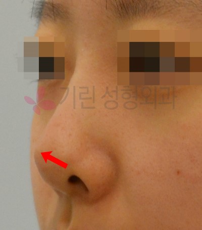 코재수술잘하는곳 : 보형물이 비치는 경우 관련 이미지 1