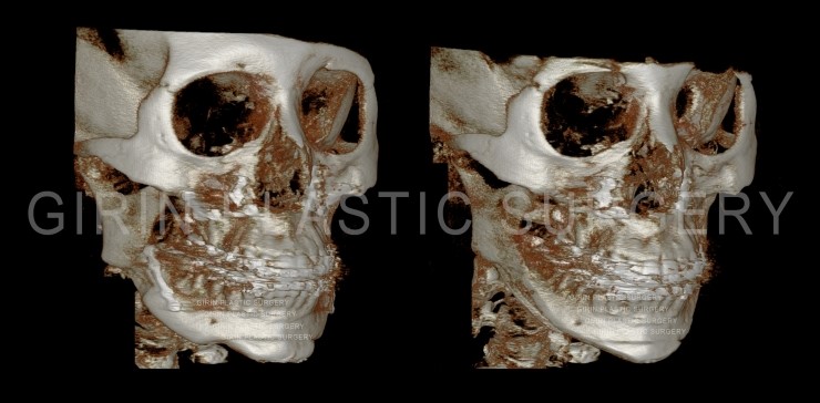 양악수술후 이차각, 라인불균형으로 인한 재수술 관련 이미지 2