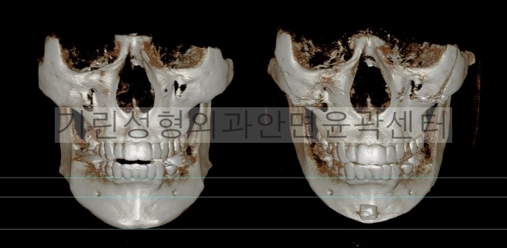 남자긴턱줄임+자가뼈앞턱수술+광대고정 수술다음날CT 관련 이미지 2