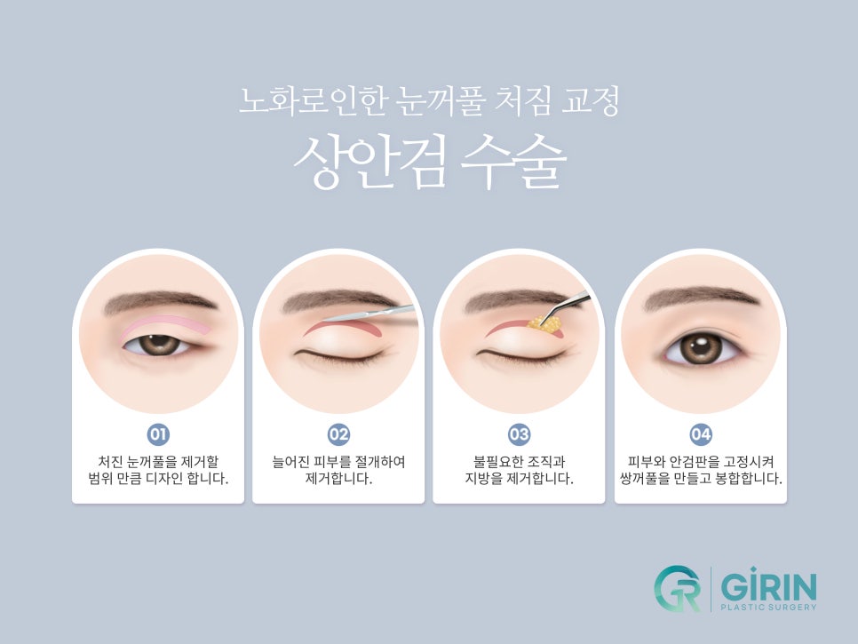 상하안검 주름 고민이 있다면 관련 이미지 4