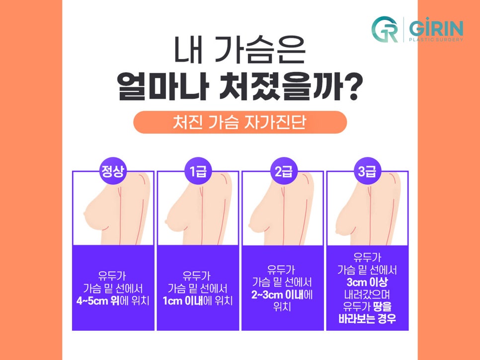 가슴처짐수술 교정으로 자신감 찾아 관련 이미지 6