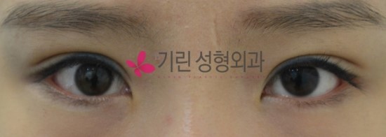 안검하수 (수술 후 6주 눈감은 사진) 관련 이미지 2