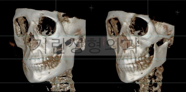 퇴원시 촬영한 긴곡선사각턱 CT영상/ 8일차 경과사진 관련 이미지 5