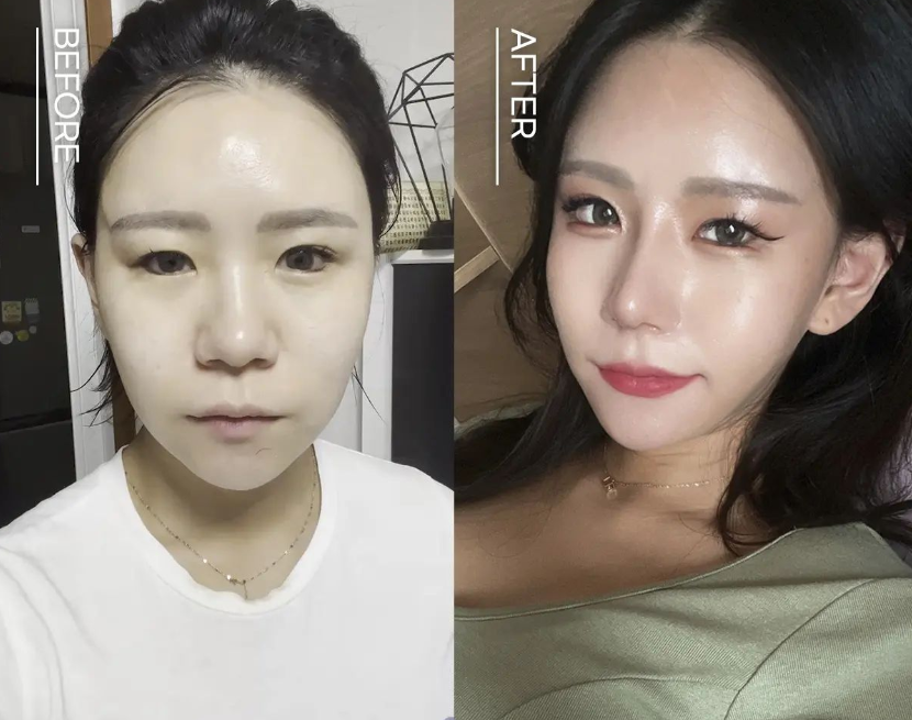 여자코성형후기 얼굴 비율까지 고려하여 관련 이미지 2