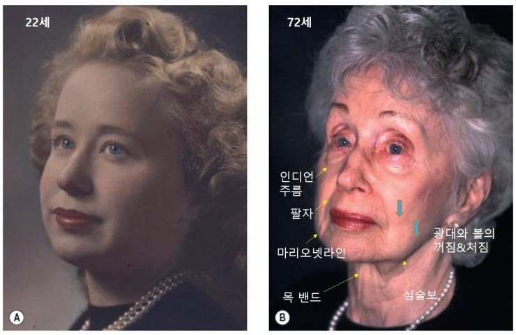 [공유] 안면거상술 고민중이시라면 꼭 읽어보세요! 안면거상술 어떤 분들에게 필요하고, 어떤 효과가 있는 수술인가? 관련 이미지 1