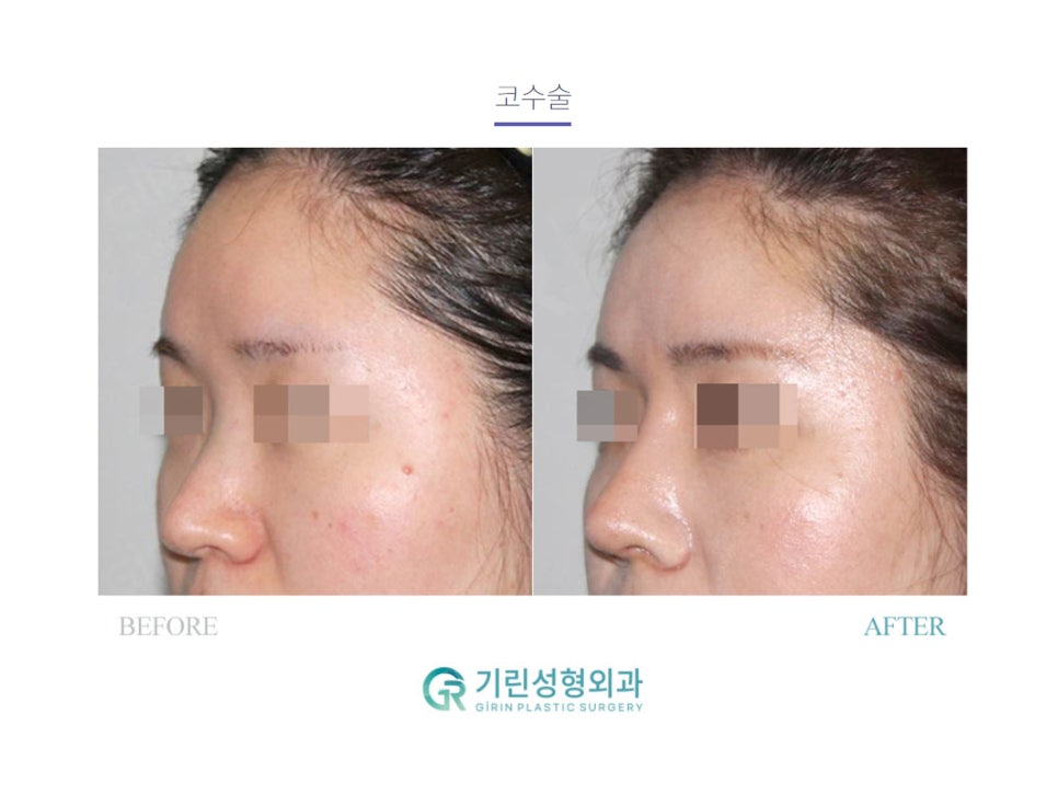 강남성형외과순위 선택은 신중하게 관련 이미지 2