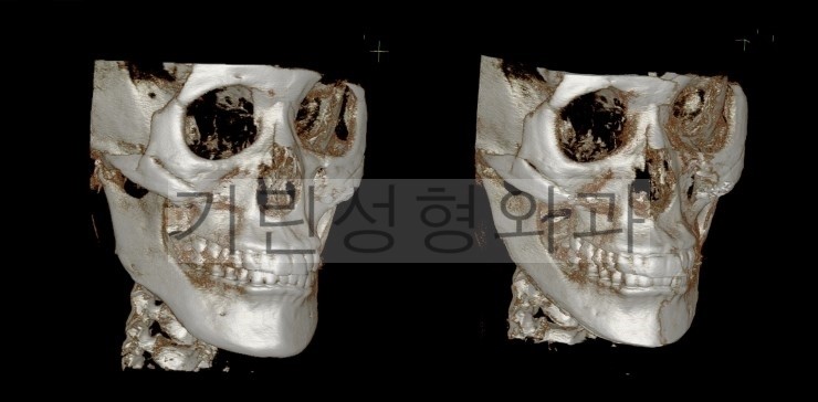 어제 재수술한 환자분의 3DCT입니다. 관련 이미지 2
