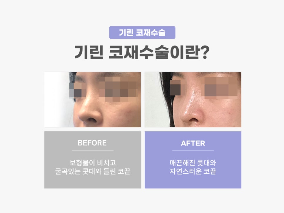 강남코재수술 신중하게 고르자 관련 이미지 2