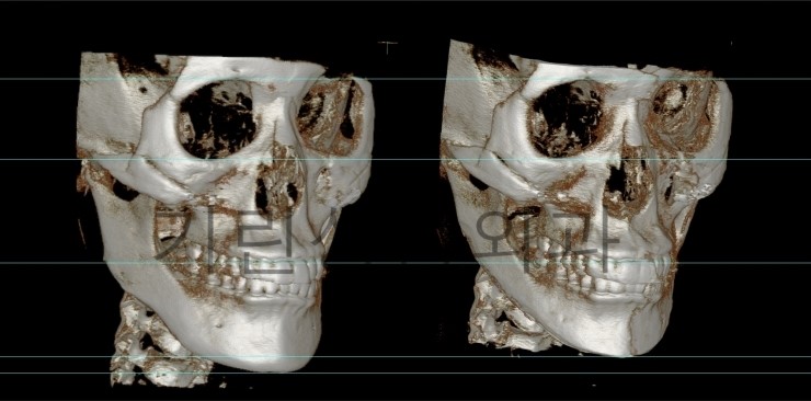 사각턱재수술 길이줄임 7일경과사진 관련 이미지 4