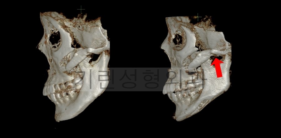 [브이라인재수술사례] 이차각제거 & 광대재수술이 필요없는 이유 관련 이미지 5