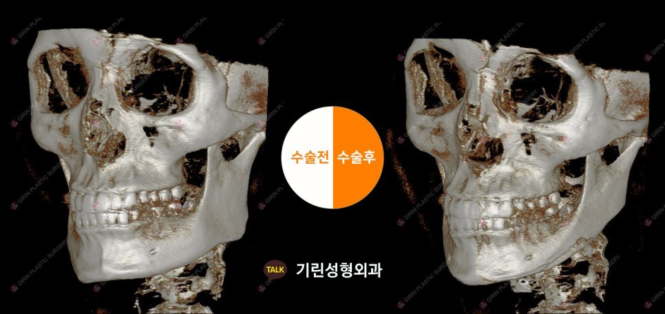 [뉴브이라인]45도 라운딩 브이라인 절골술로 작은 얼굴 만들기 관련 이미지 7