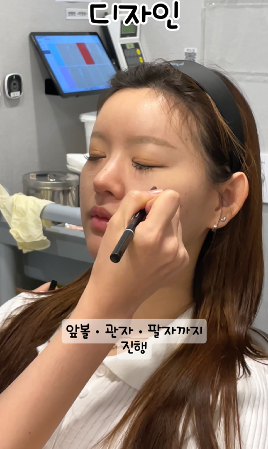 기린성형외과 쥬베룩볼륨 팔자주름, 앞볼, 관자 후기 관련 이미지 6