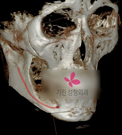 무리한 성형수술[사각턱신경선의 손상] 관련 이미지 1