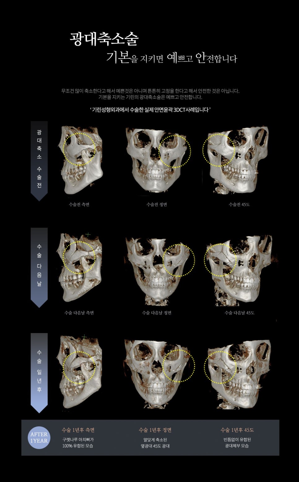 기린 성형외과는 광대축소술을 어떻게 진행하나요? 관련 이미지 2