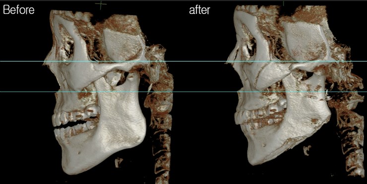 광대 부분절골- 광대비고정사례 관련 이미지 3