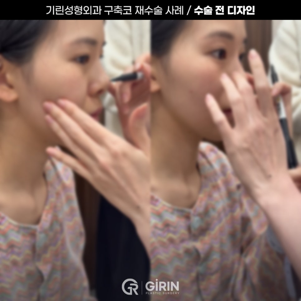 기린성형외과 코성형 구축코 재건 사례 관련 이미지 3