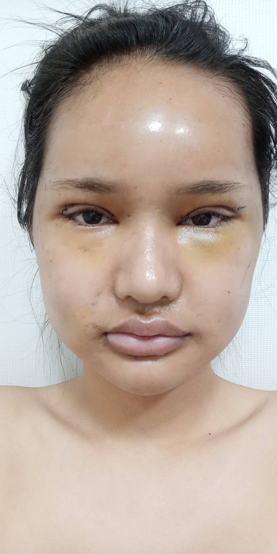 [사각턱축소 최다수술 이승룡원장] 태국에서 온 그녀의 윤곽 수술 후기 리얼 스토리&hearts; 관련 이미지 4