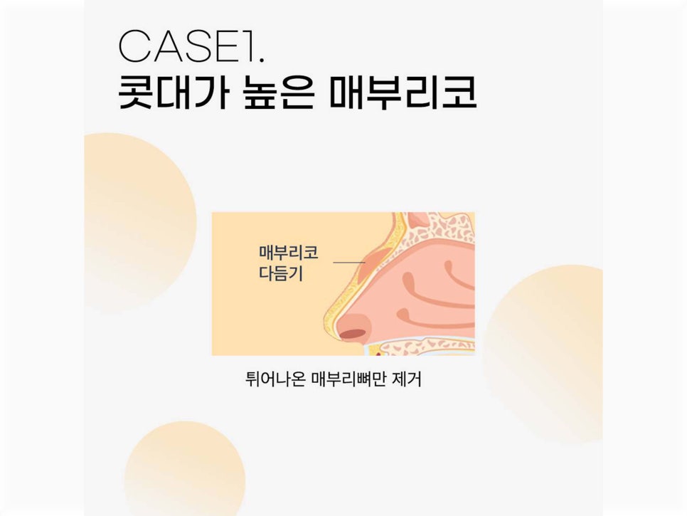 매부리코수술후기 올바른 라인으로 관련 이미지 9