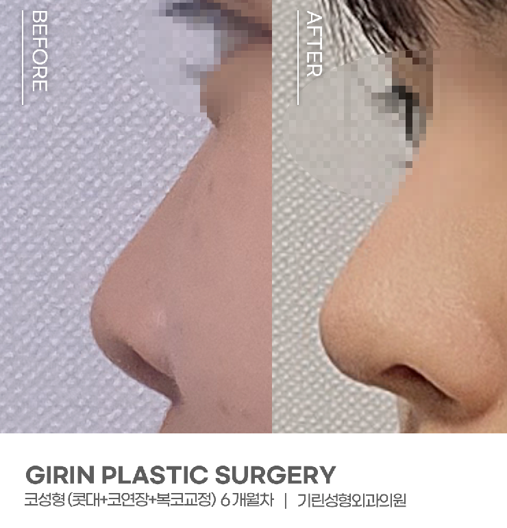 코성형 종류 비교하고 맞춰서 관련 이미지 1